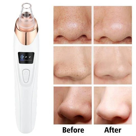 5-in-1 Rechargeable Blackhead Remover | Derma Suction Pore Cleaner