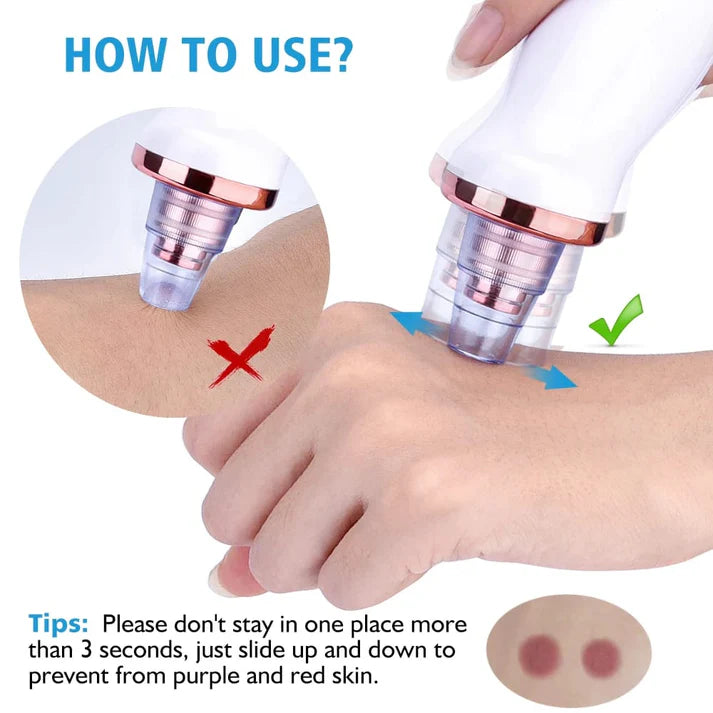 5-in-1 Rechargeable Blackhead Remover | Derma Suction Pore Cleaner