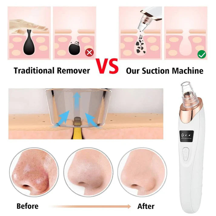 5-in-1 Rechargeable Blackhead Remover | Derma Suction Pore Cleaner